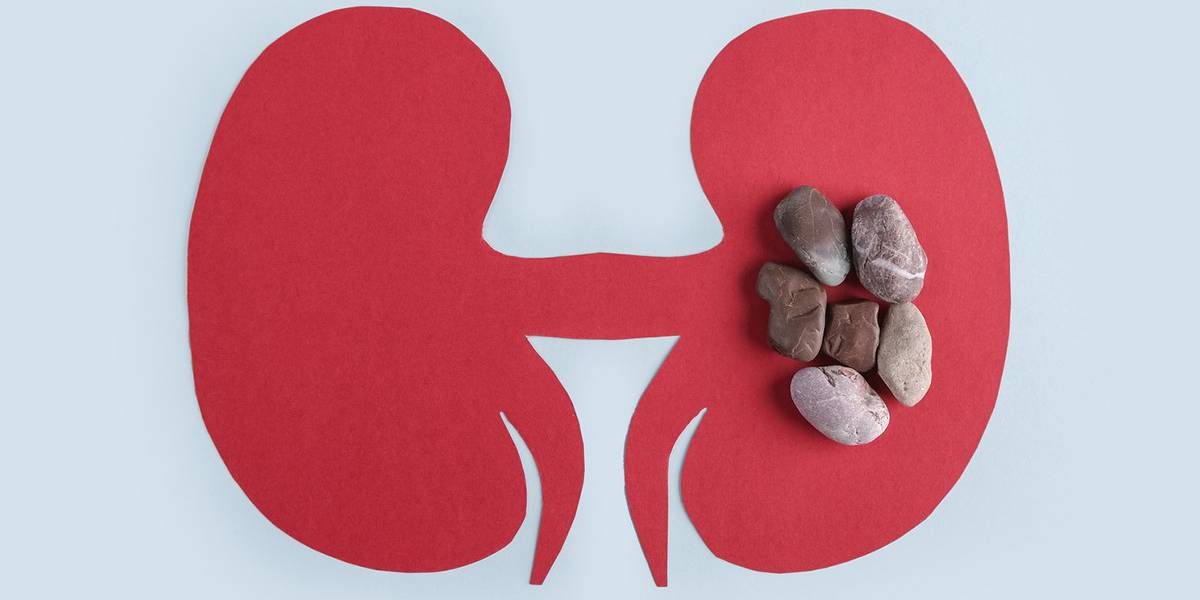 انتخاب بهترین روش سنگ شکن کلیه