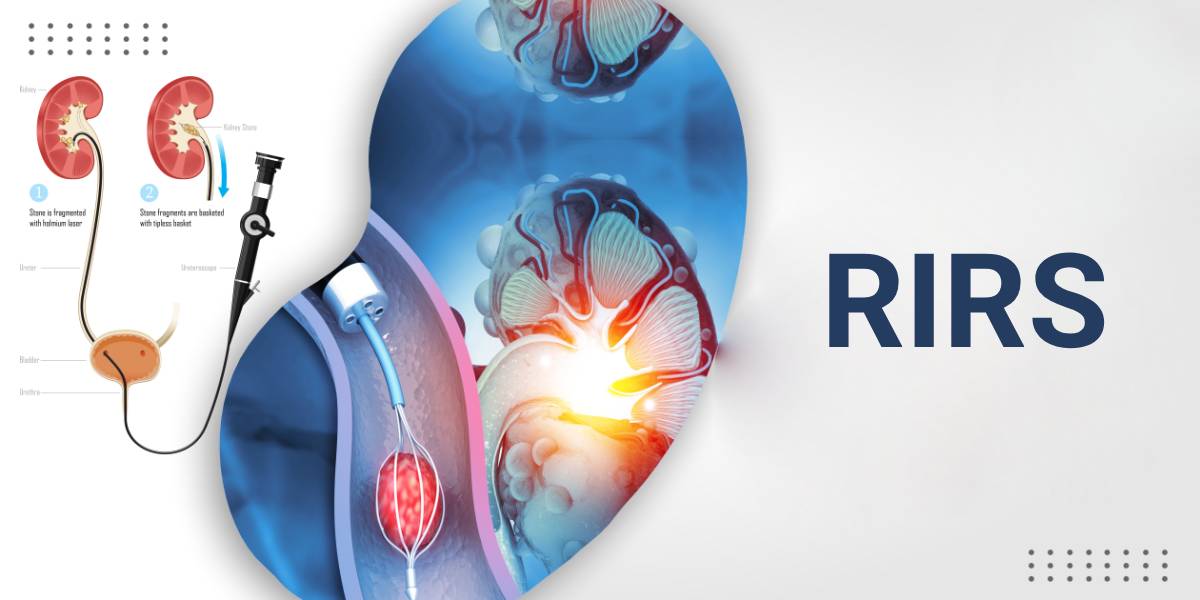 روش درمان سنگ کلیه با RIRS