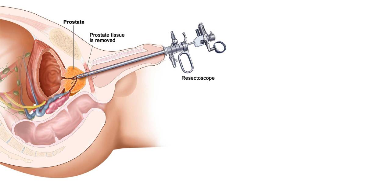 روش جراحی لیزری پروستات
