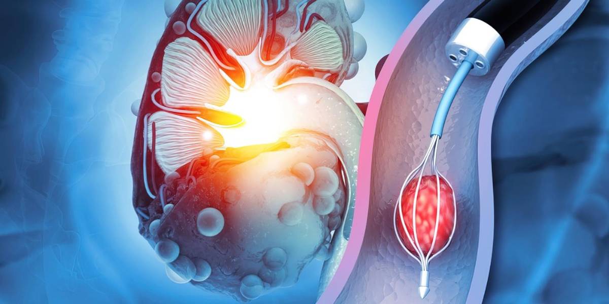 مزایای درمان سنگ کلیه با RIRS