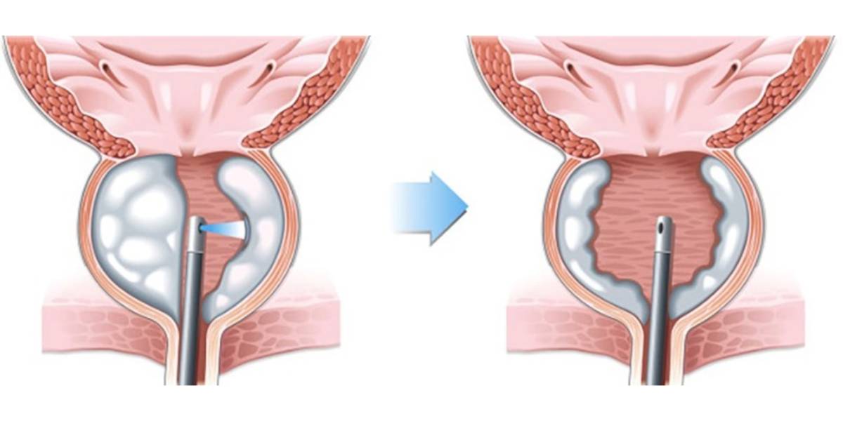 مزایای جراحی لیزری پروستات